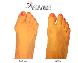 Before & After Foot 8