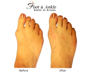 Before & After Foot 9