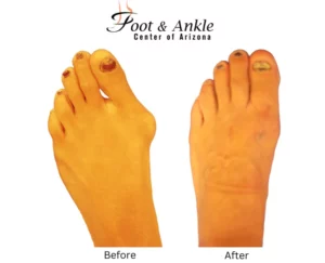 Before & After Foot 10