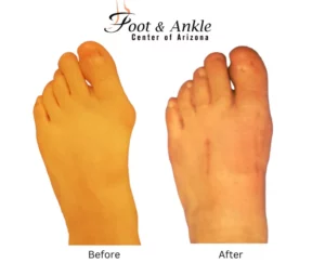 Before & After Foot 11