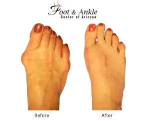 Before & After Foot 12