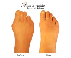 Before & After Foot 13