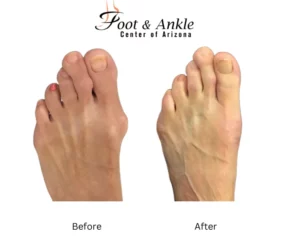 Before & After Foot 14