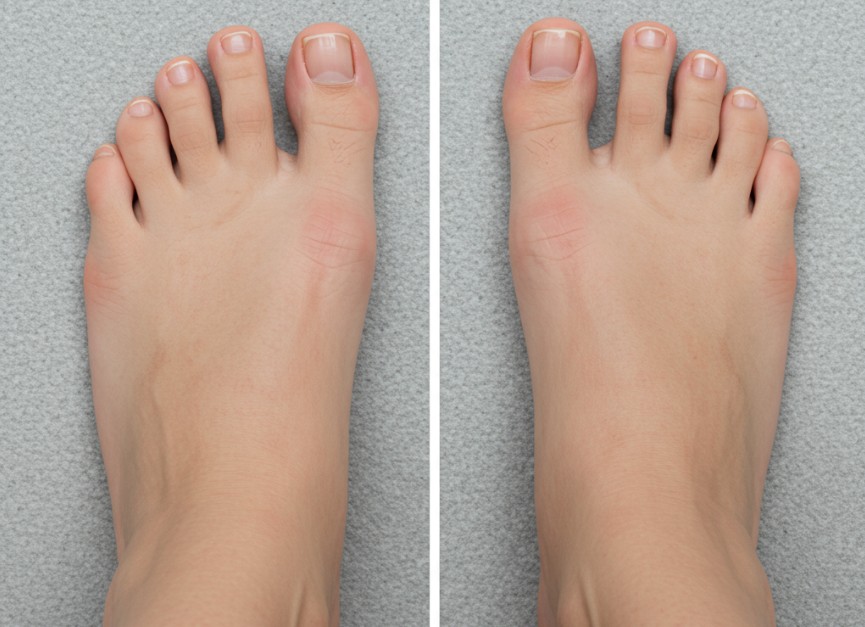 Cosmetic Foot Surgery