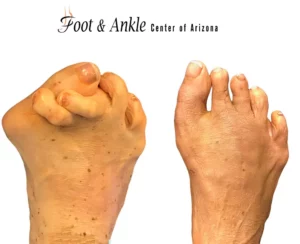 foot issue before and after 1