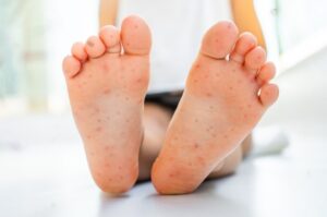 Common Foot Hazards