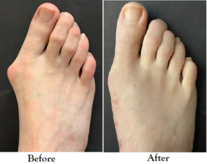 Bunion Treatment Before and After