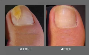 Nail Fungal Image
