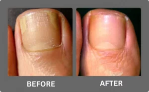 nail fungals before and after