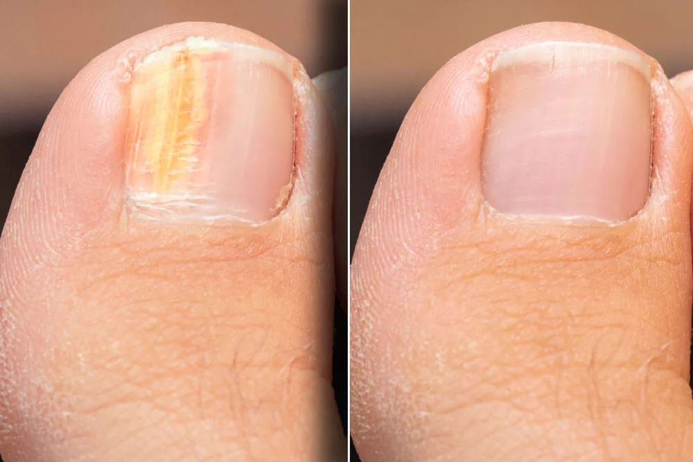 How To Treat Fungal Nails – My FootDr