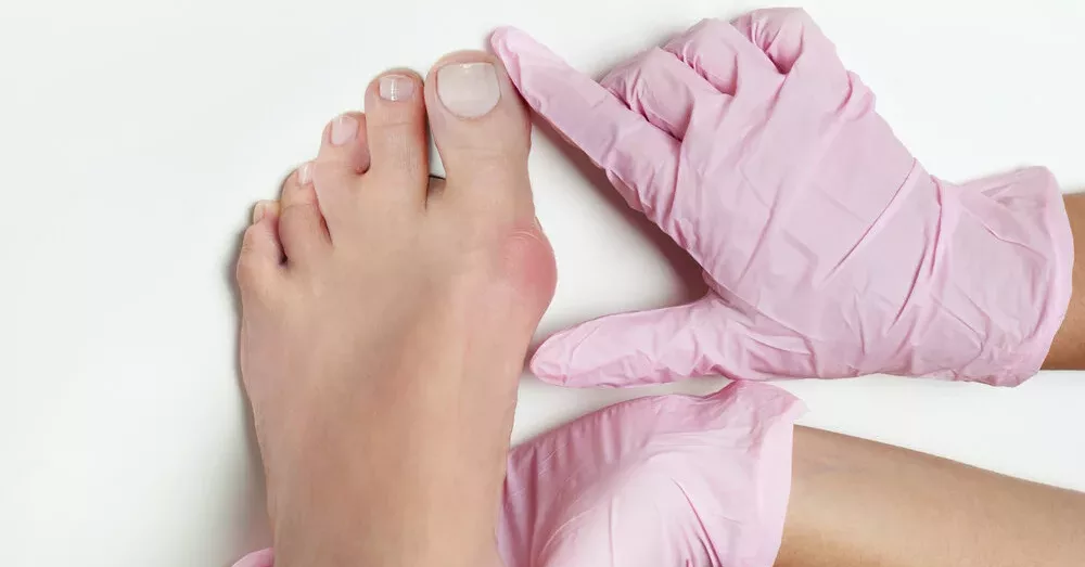 Bunion Surgery