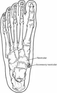 Accessory Navicular Syndrome01