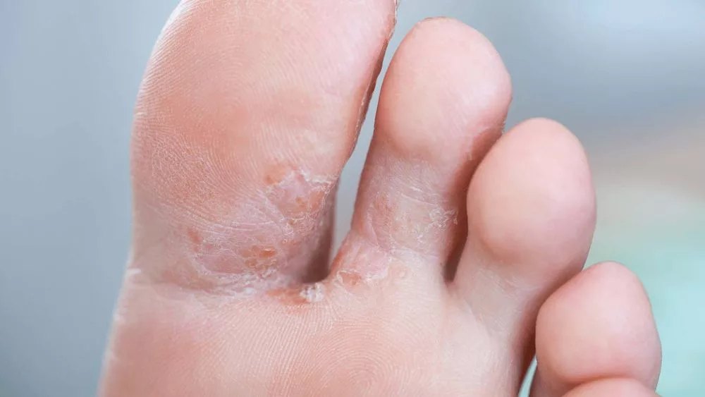 Athlete's Foot