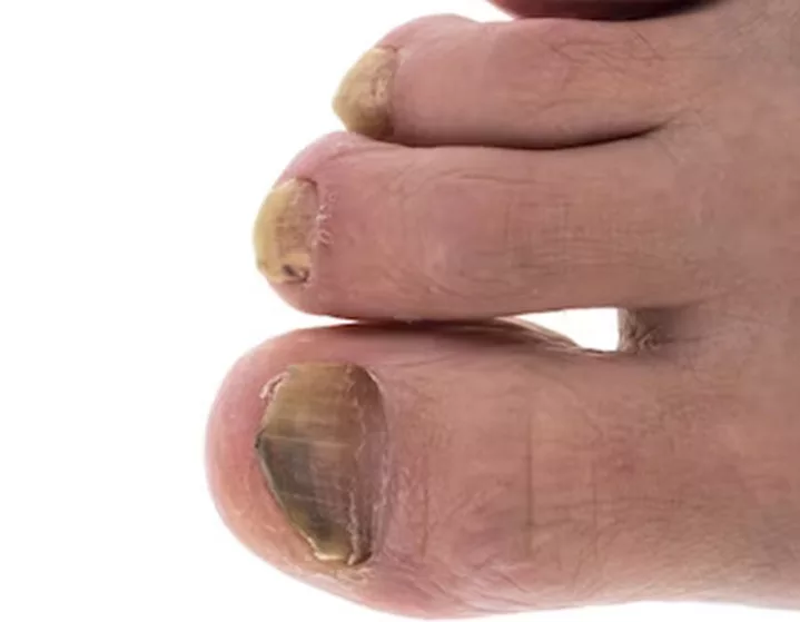 Toenail Discoloration: The Colors and What They Mean | Chicago DPM