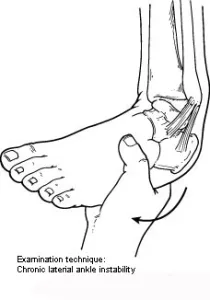 Chronic Ankle Instability bone