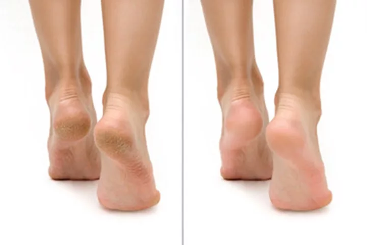 Painful Heel Crack Rhagades Fissures Cracks Stock Photo 267949796 |  Shutterstock