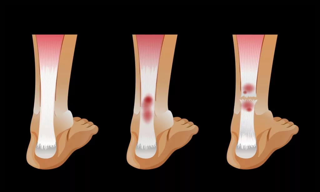 calcaneal fractures (Heel Bone Fractures)