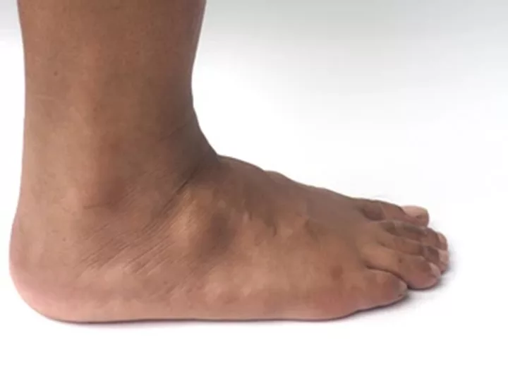 Ganglion Cyst on Foot photo