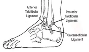 Ankle Sprain picture 