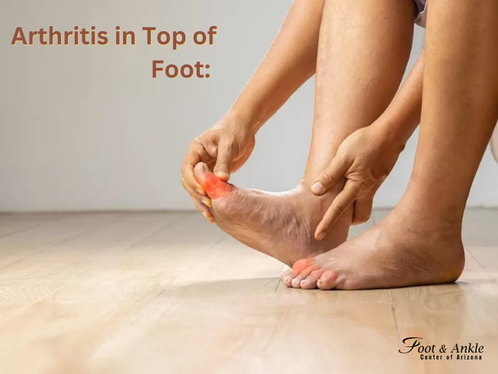 Arthritis in Top of Foot