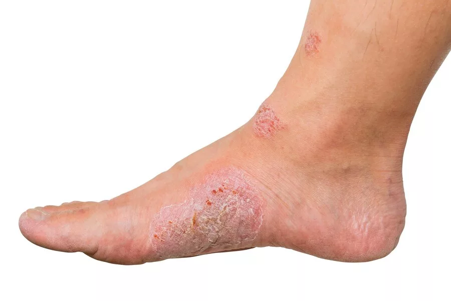 Eczema of the Foot treatments