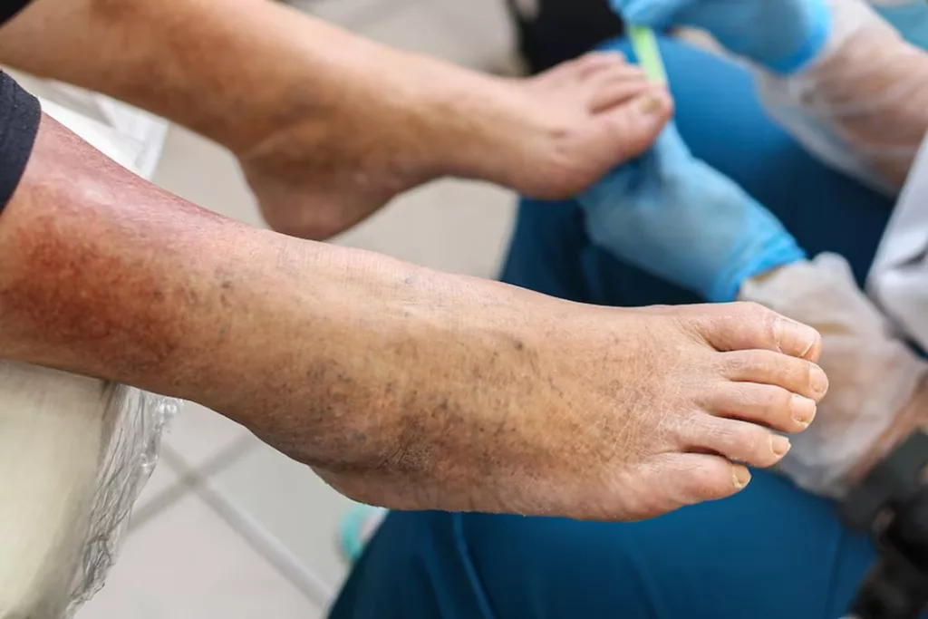 Foot Rashes: Types, Origins, and Treatments