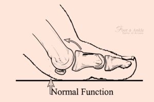 Hallux Rigidus