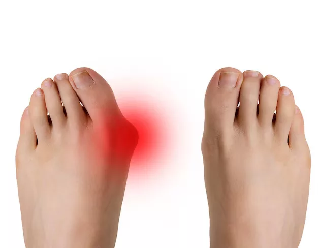 Joint Swelling in the Foot picture