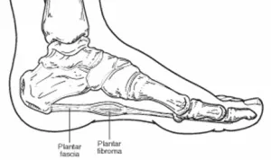 Plantar Fibroma treatment