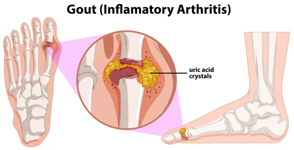 diagram showing gout human foot