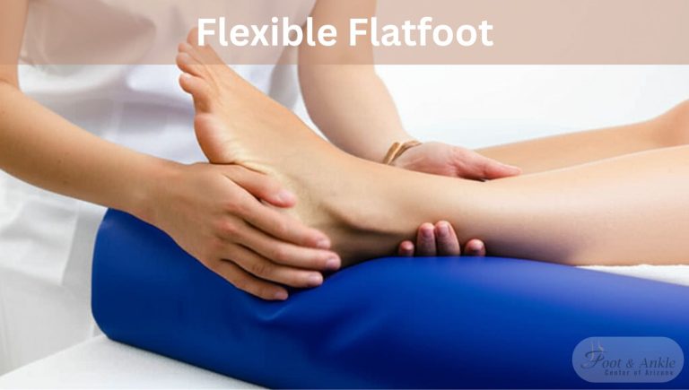 flexible flatfoot