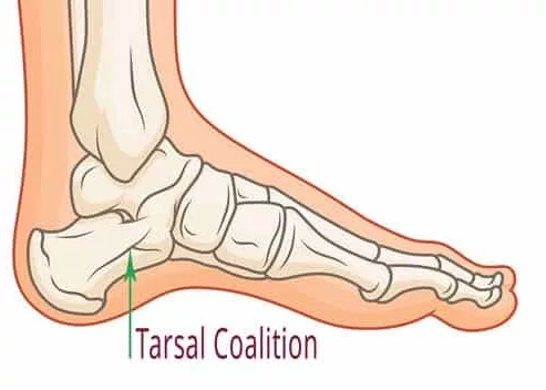 Tarsal Coalition-graphic representation treatment
