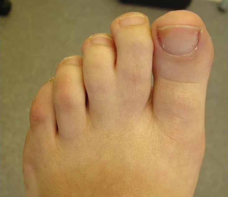 Webbed Toes-problem and treatment