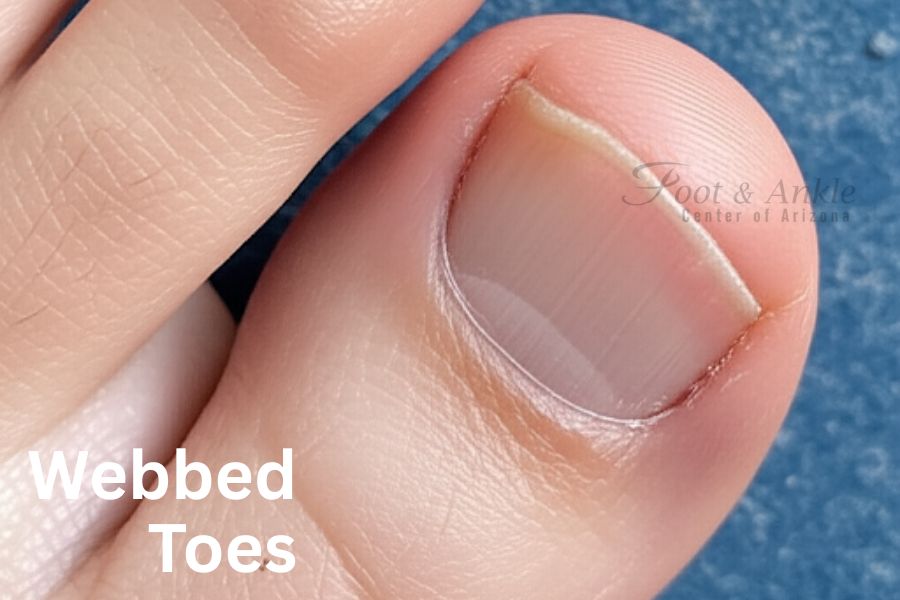 Webbed Toes