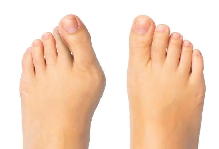 Minimally Invasive Bunion Surgery