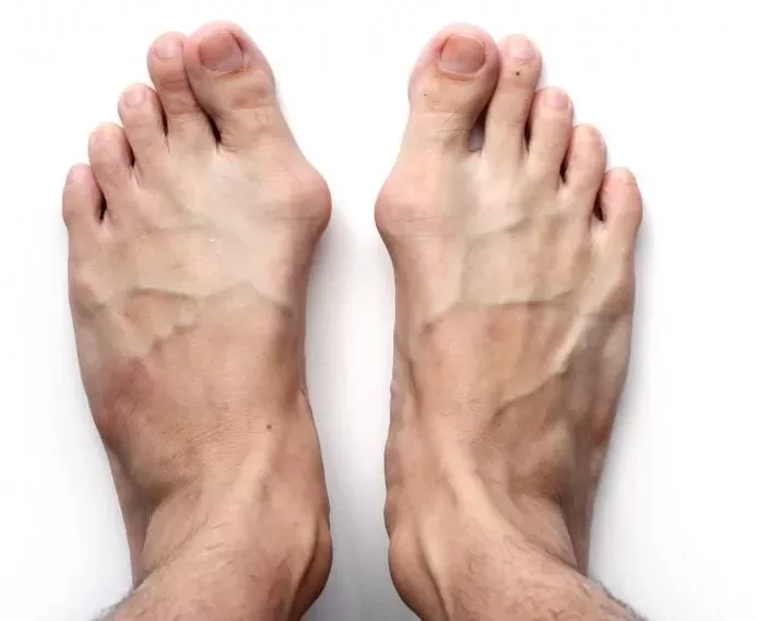 What Does Bunion Pain Feel Like