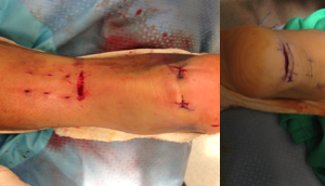 Achilles tendon treatment