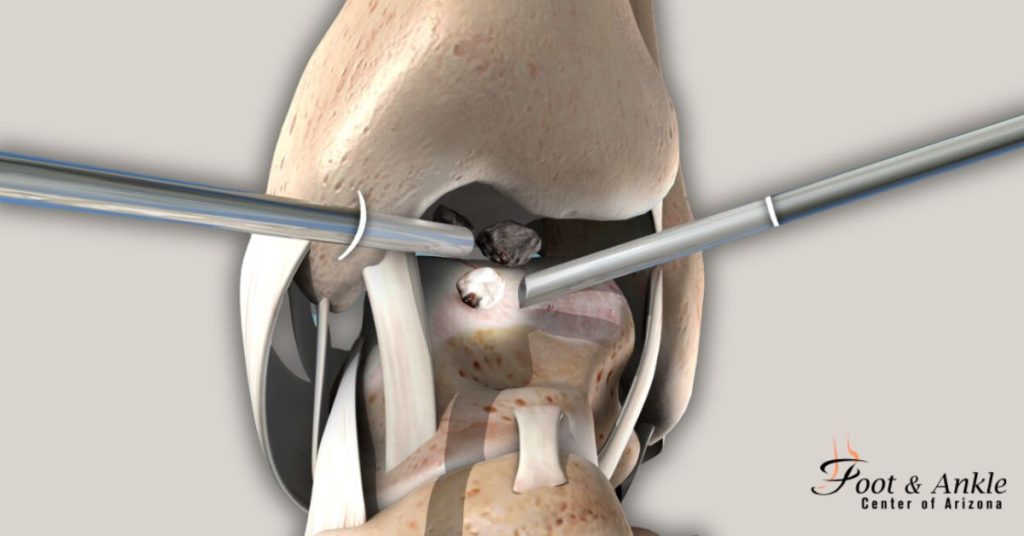 Arthoscopic Ankle Cartilage Repair