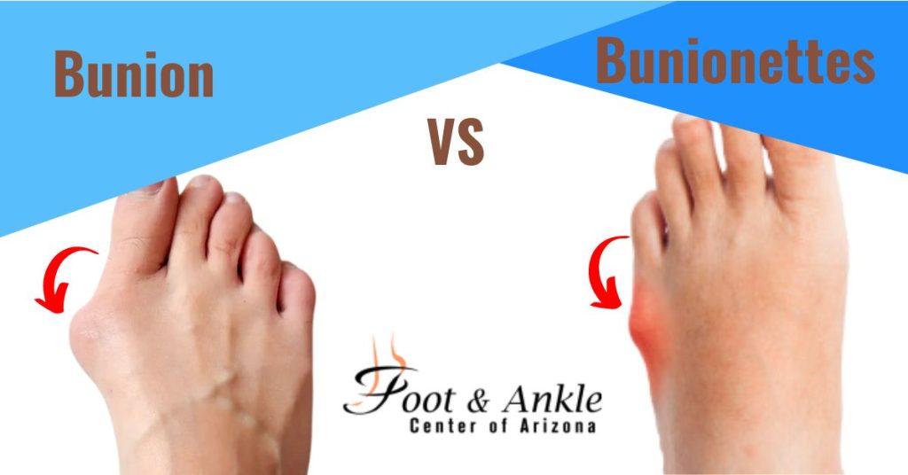 Bunions and Bunionettes