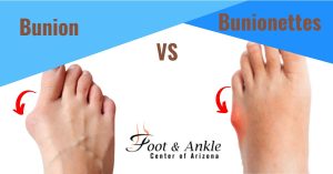 Bunions and Bunionettes