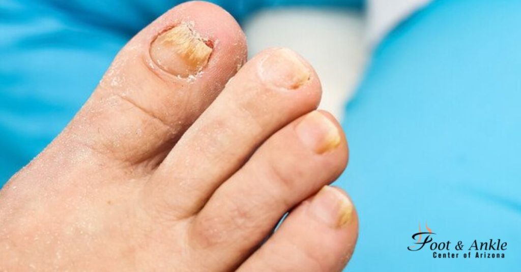 Fungal Toenail Therapy