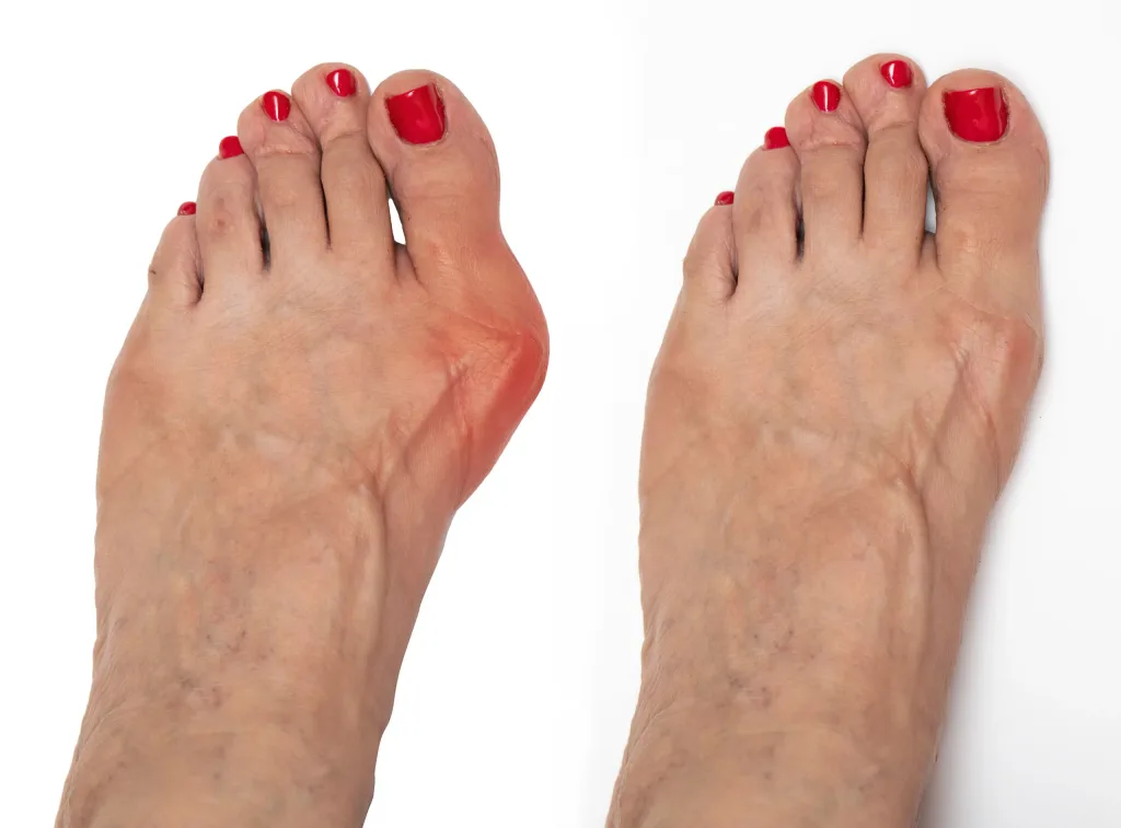 Bunion Surgery