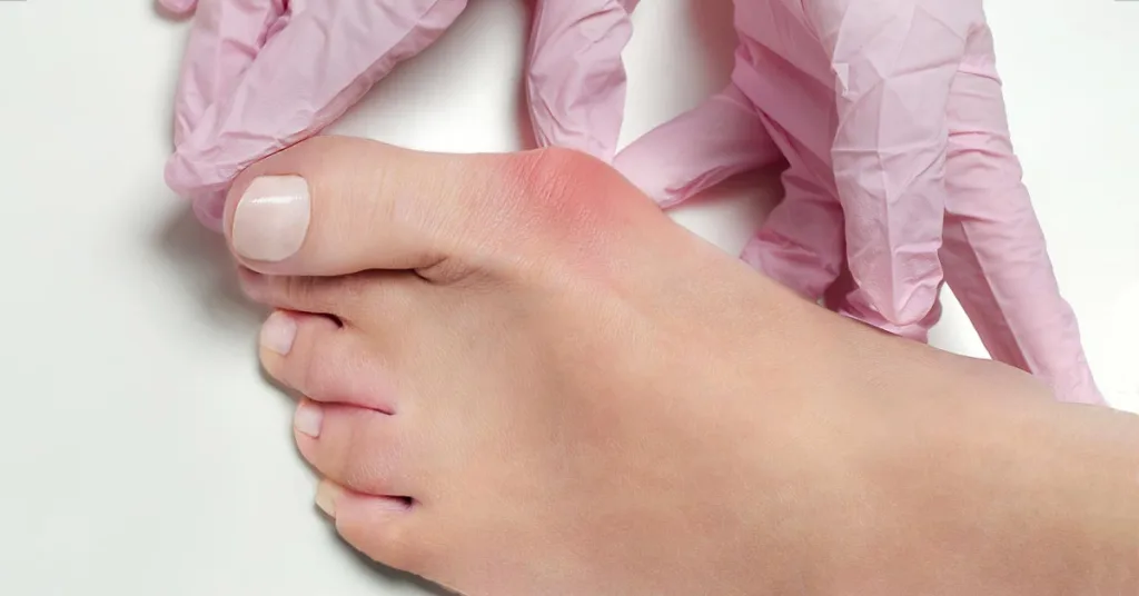 Minimally Invasive Bunion Surgery in Phoenix