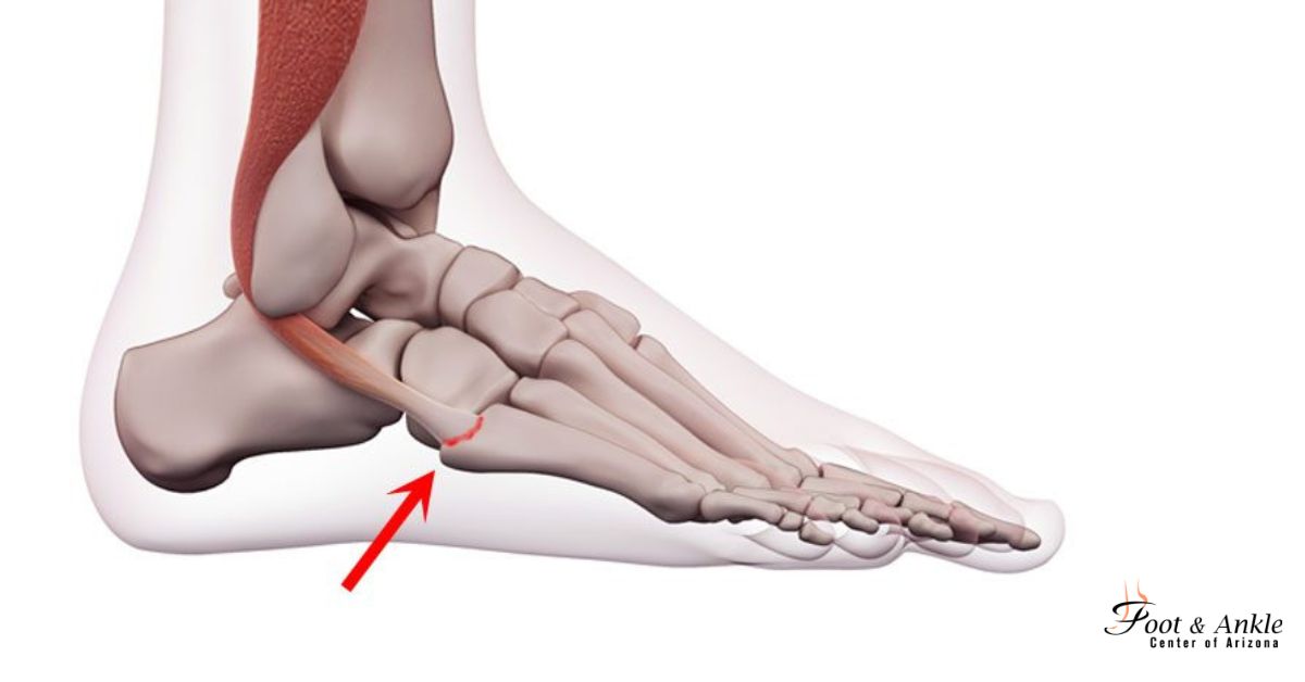 Non-Surgical Ankle Tendon Injuries