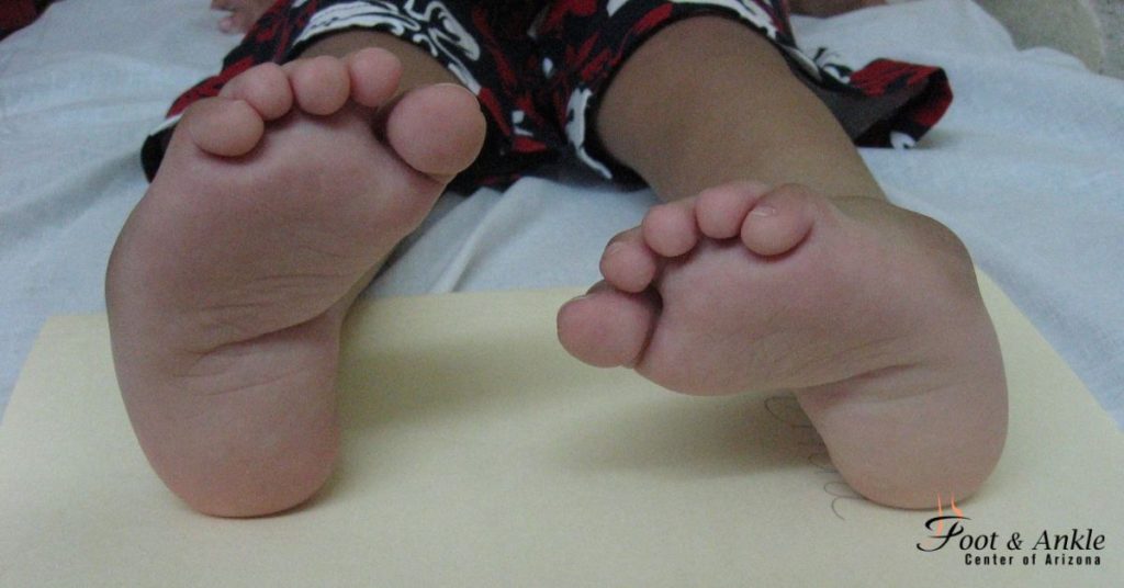 Ponseti Method for Treating Clubfoot