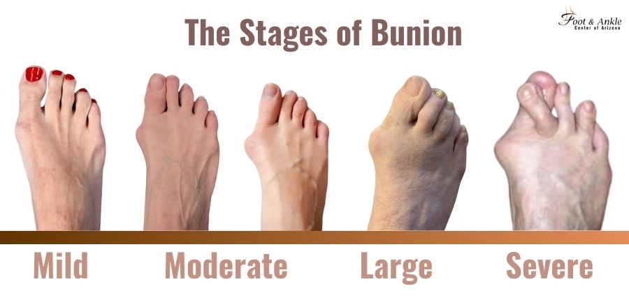 minimally invasive bunion surgery - Bunion Stages Guide