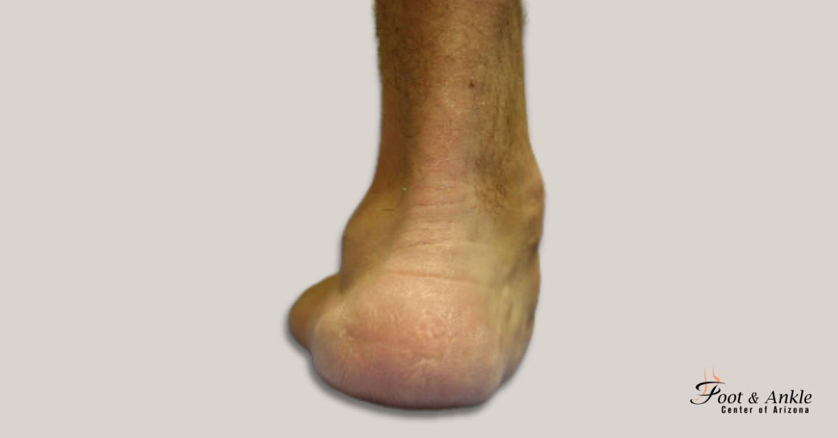 Flatfoot Deformity treatment