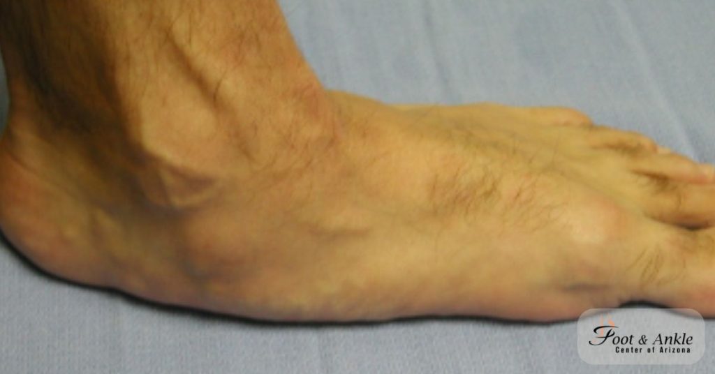 Flatfoot Deformity