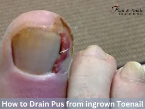 How to drain pus from ingrown toenail