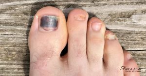 Why is my Toenail Black and Thick